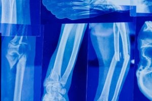 X-rays featuring human bones